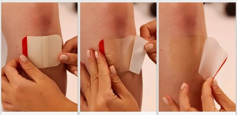 Manfaat dan Penerapan Hydrocolloid pada Dermatologi